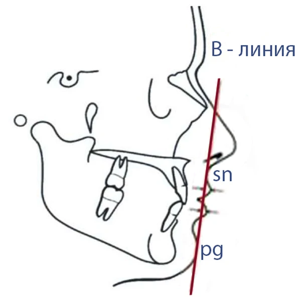 B-line, B-изгиб