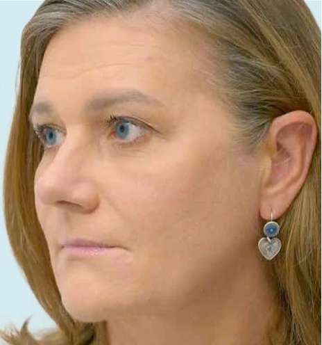 Качество кожи после применения филлера Radiesse®